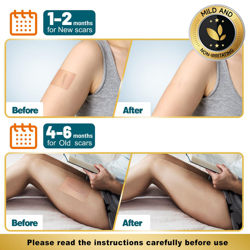 Arme Silicone Scar Tape, 1.6"x480" Silicone Scar Sheets(4 Rolls-12M) Medical Grade Scar Tape for Surgical Scars, Reusable Scar Patches, Professional Scar Removal Strips for C-Section Keloid Tummy Tuck 480" - 12M (4 Rolls)