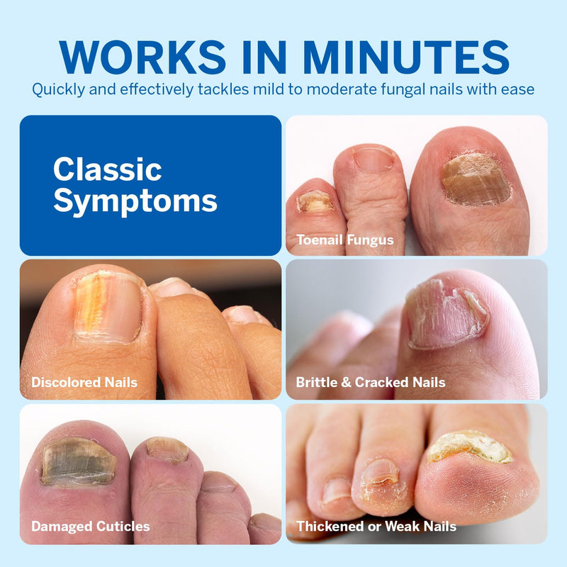 Toenail Fungus Treatment Extra Strength - Toe Nail Fungus Treatment Extra Strength - Nail Fungus Treatment for Toenail and Finger Nail