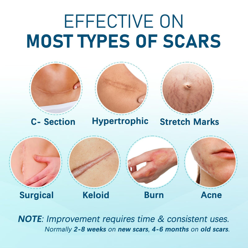 Silicone Scar Sheets, Large 10Pcs 4” x 7” Each, Medical Silicone Tape for Scar Treatment, Scar Patches for C-Section, Keloid Bump, Stretch Marks, Burn, Acne, Surgical Scar Removal 10 Sheets (each 4”x7”) - BeesActive Australia