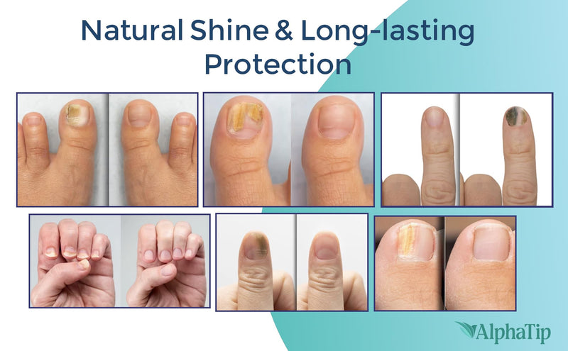 Toenail Treatment & Nail Repair Pen, Nail Strengthener and Care Solution for Damaged, Brittle Nails – Gentle Botanical Formula, Easy Twist Pen – 2 Packs × 2 (4 Pens Total) 0.1 Fl Oz (Pack of 4)