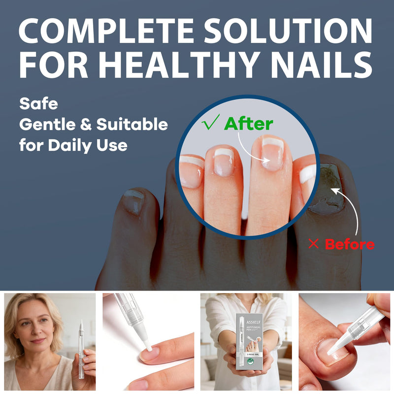 FSA Eligible HSA Extra Strength Athlete‘s Foot & Toenail Fungus Treatment Pen, Toenail Treatment Pen with 25% Undecylenic Acid, Precision Applicator for Itch Relief & Nail Car - 3 Pack/6 Pack (3 Pack) - BeesActive Australia