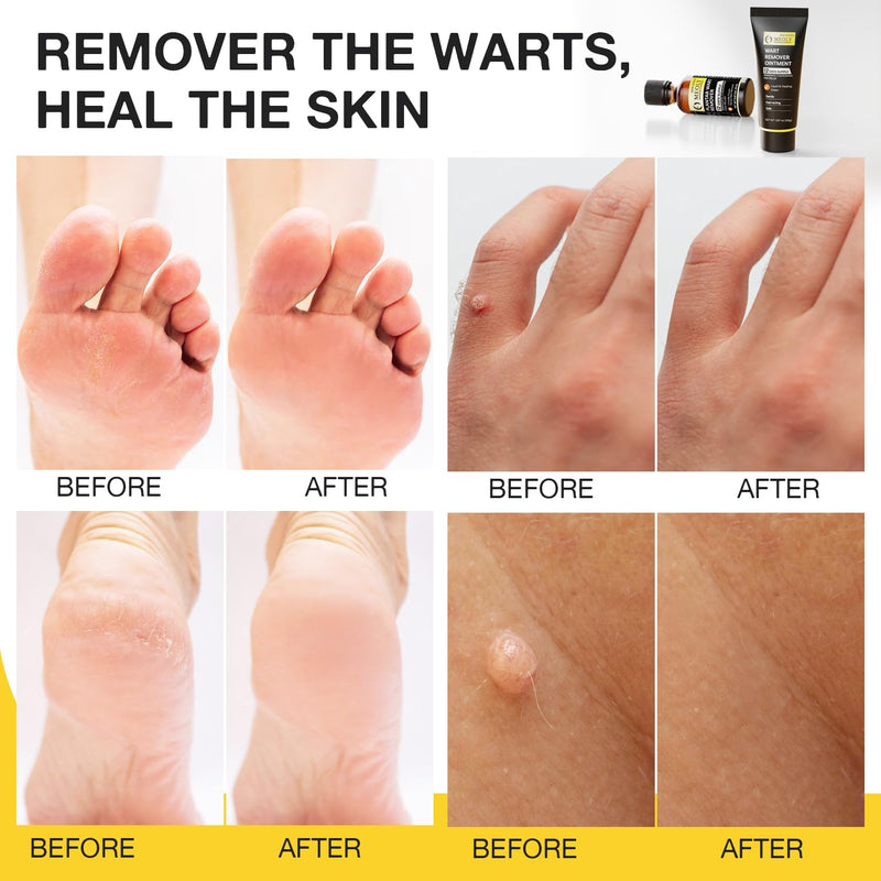 Plantar Wart Remover Set: Maximum Strength Salicylic Acid Plantar Wart Remover 12 Thick Cushioning Pads 1.5