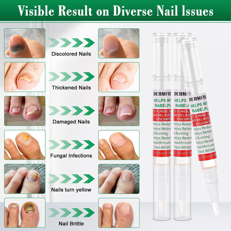 Toe Nail Fungus Renewal Pen, Toenail Fungus Renewal, 3 Packs Powerful Fast Acting For Thick, Discolored, Broken & Damaged Toe & Finger Nail 0.4 Fl Oz (Pack of 1)