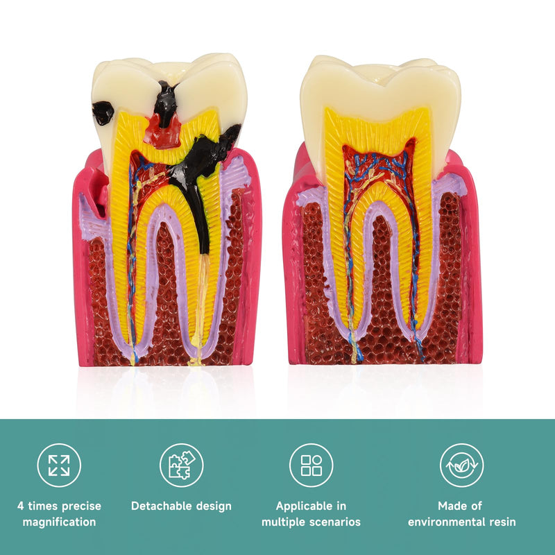 Ultrassist Dental Tooth Decay Model, Dental Caries Demonstration Model, Tooth Anatomy Teaching Model for Dental Education, Patient Explanation and Oral Health Classroom Teaching - BeesActive Australia