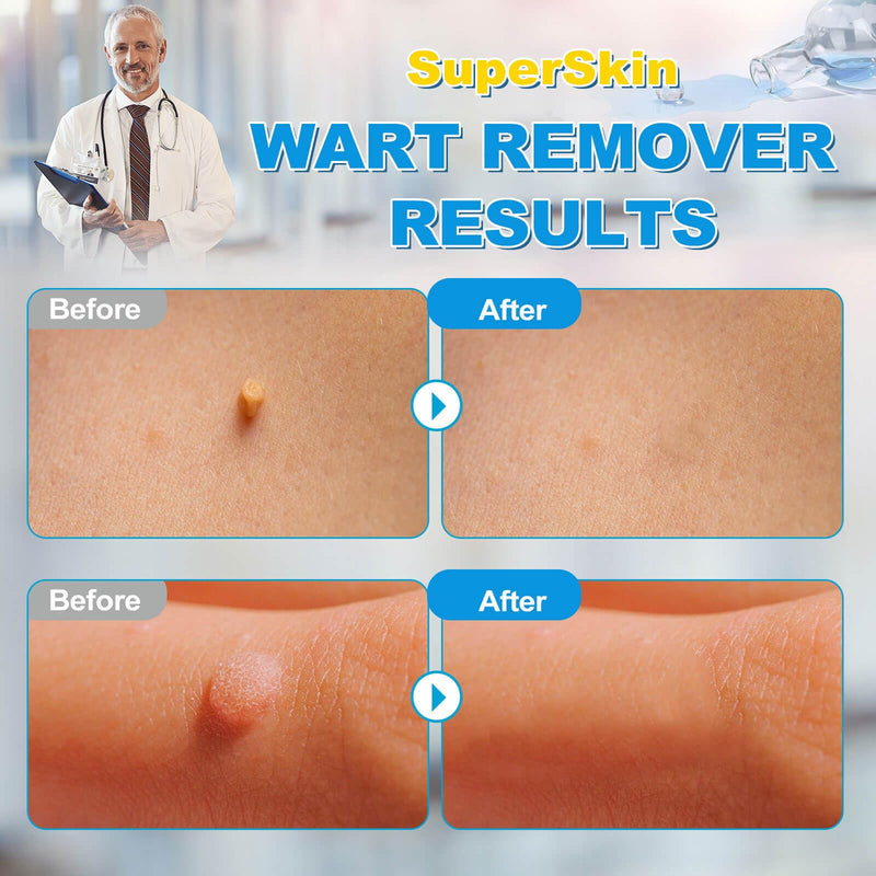 Fast Action Liquid Wart Gel Maximum Strength - Wart Liquid with Salicylic Acid - Fast-Acting Wart Liquid Freeze Off Designed for Warts, Plantar Wart, Genital Wart, Common Wart, Flat Wart, Corn, Callus Clear - BeesActive Australia