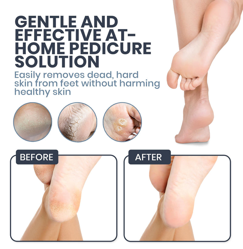 Upgraded 2025 Electric Foot File – Callus Remover for Women & Men with Adjustable Speed, 60 Sanding Pads & Dead Skin Exfoliation – at-Home Pedicure Tool for Dry, Cracked Feet(Black) Black - BeesActive Australia