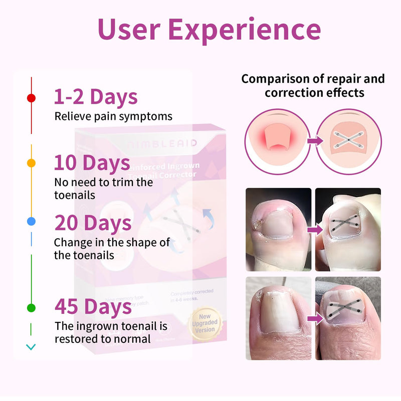 10 Patchs X-Shaped Upgrade Titanium Alloy Ingrown Toenail Corrector,At Home Ingrown Toenail Treatment for Man and Women,Ingrown Toenail Removal Kit,Curved Toenail Straightener (1 Count (Pack of 16)) 1 Count (Pack of 16)