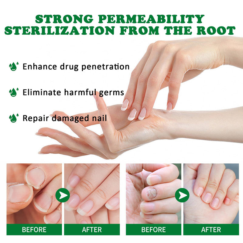 Nail Fungus Treatment Gel, Nail Fungus Treatment Cream,Multi-Purpose Nail Repair Oil Serum (1pcs) 1pcs