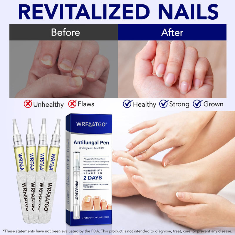 Toenail Fungus Pen, Toenail Fungus Treatment Extra Strength, 25% Undecylenic Acid for Fingernails & Toenails, Toe Nail Treatment, 4PCS Fungal Nail Care Pen with Tea Tree Oil & Oregano Oil
