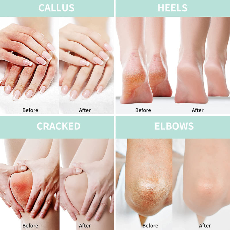 Grocerism Urea Cream 40 Percent For Feet Plus 2% Salicylic Acid 5.29 oz || Foot Cream and Hand Cream Maximum Strength with Hyaluronic Acid,Tea Tree,and Aloe Vera For Deep Moisturizes,Callus Remover 5.29 Ounce (Pack of 1) 40%