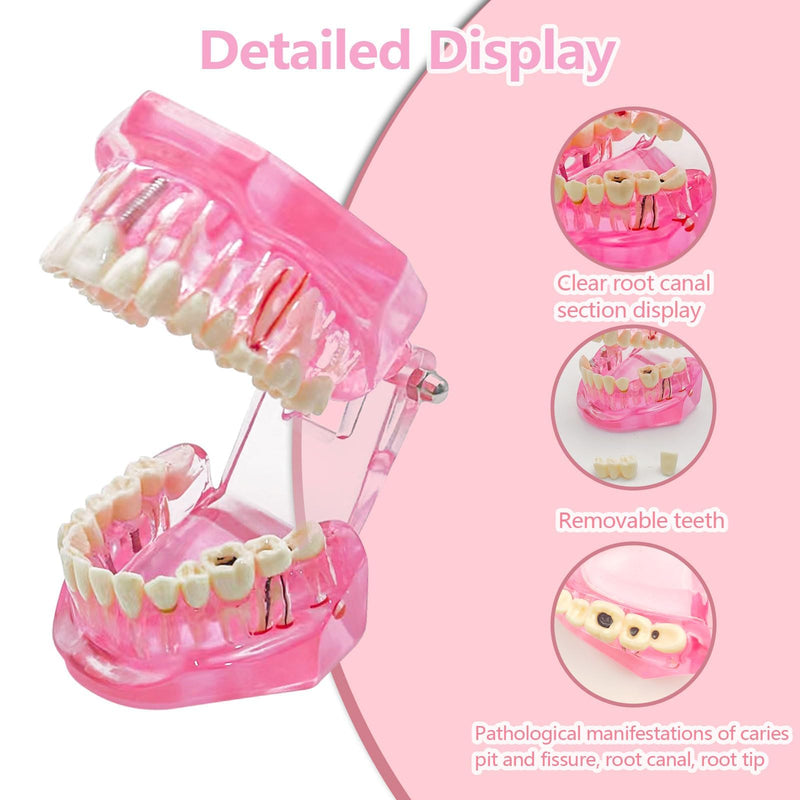 Transparent Disease Teeth Model with Dental Implant Bridge, Dental Teach Crown Bridge Removable Model, Tooth Model for Patient and Dental Student Education. (Red) Red - BeesActive Australia