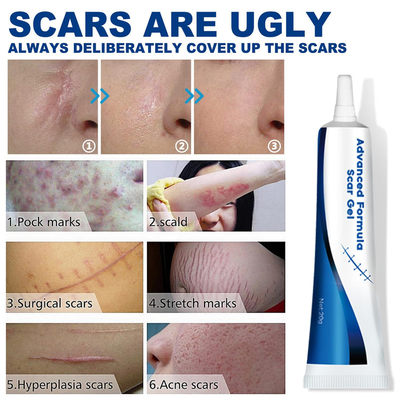 Advance Scar Gel, Scar Cream, Advanced Formula Scar Gel for Old & New Scars, Surgical Scars, Face, Body, Leg, Burns, Acene, C-Section, Stretch Marks, Keloids, Scar Removal for Adults & Kids