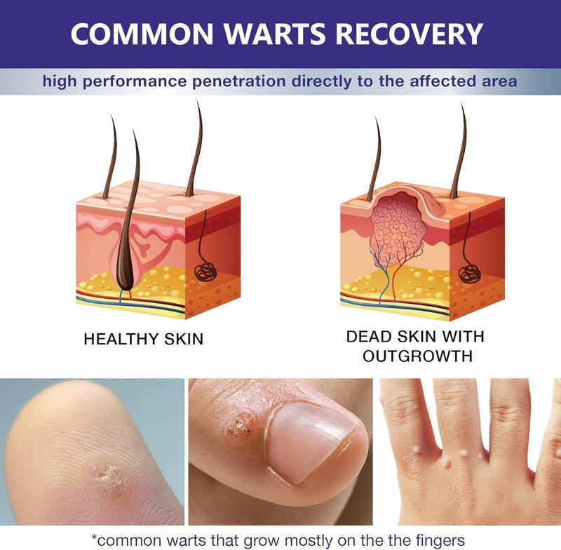 Fast Acting Gel Wart Remover Freeze Off - Fast-Acting Wart Freeze Off - Wart Removal for Plantar Wart, Genital Wart, H Warts, Common Wart, Flat Wart, Corn, Callus, Warts, Plantar Wart Remover for Feet Clear - BeesActive Australia