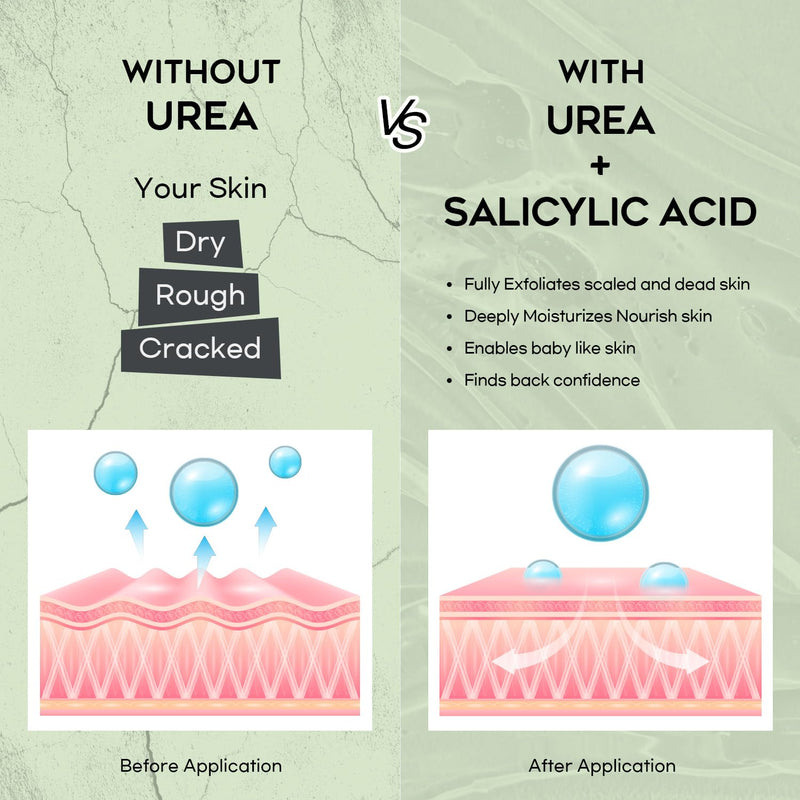 Urea Cream 42% Foot Cream Salicylic Acid 4 Oz, Upgraded Callus Remover For Feet, Knees& Elbows, Intensive Moisturizes & Softens Skin, Exfoliates Dead Skin - BeesActive Australia