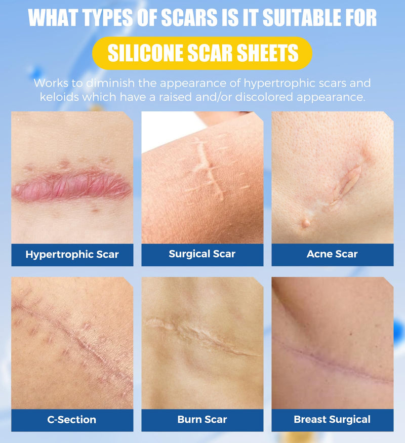 MasterMo Medical Grade Silicone Scar Sheets & Tape - Ultra Soft, Hypoallergenic Rolls (1.6‚Äùx60" Roll) for Surgical, C-Section, Tummy Tuck, Keloid Scars, Stretch Marks & Burn Scar Removal 1.5M - BeesActive Australia