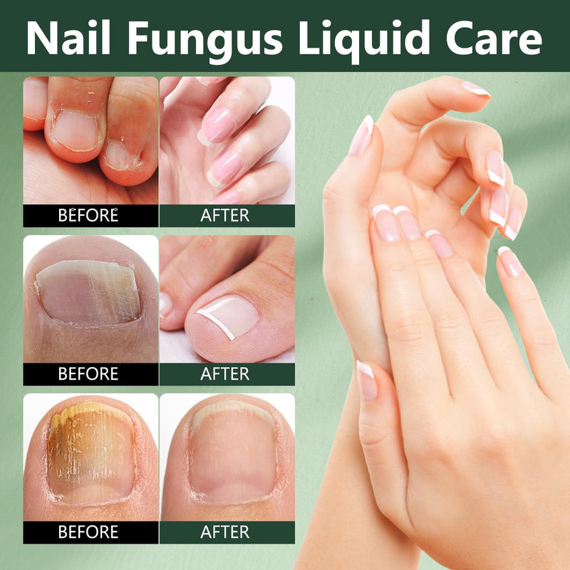 7 DAYS Tea Tree Ginger Nail Treatment, Clysburtuony Ginger Nail Growth Serum &30ml Liquid Serum with 20 Renewal Patches, Cuticle Care, 2-Pack (Standard-A) 0.5 Fl Oz (Pack of 2)