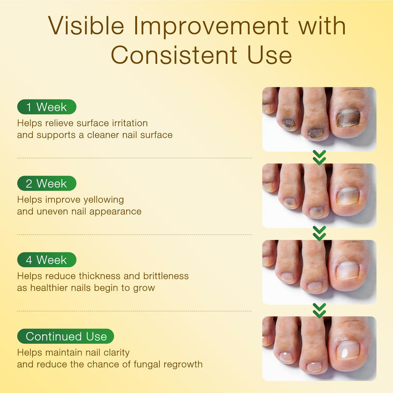 Toenail Fungus Treatment with 25% Undecylenic Acid & Tolnaftate - SafeFight Nail Repair Solution for Fungi Nail, Toenail Fungus Treatment Extra Strength Nail Repair for Fungi Nail 30ml - BeesActive Australia