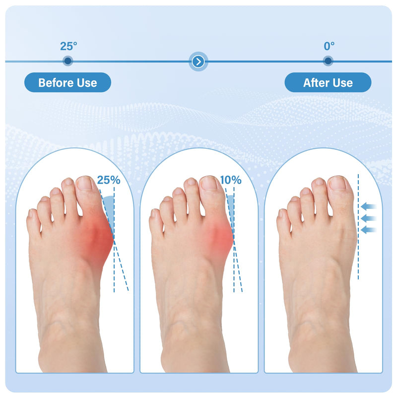 Bunion Corrector for Men and Women, Adjustable Big Toe Straightener & Alignment Splint for Hallux Valgus Pain Relief, Day and Night Support, Fits in Shoes - Medium, 2 Pcs - BeesActive Australia