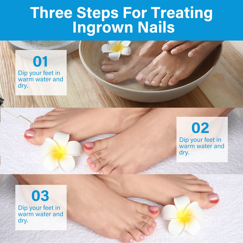 Ingrown Toenail Treatment, Ingrown Toenail Corrector Drops, 30ml Fast-Acting Ingrown Toenail Softener & Care Solution, Plant-Based Formula for Easier Trimming, Gentle for All Ages 1 Fl Oz (Pack of 1)
