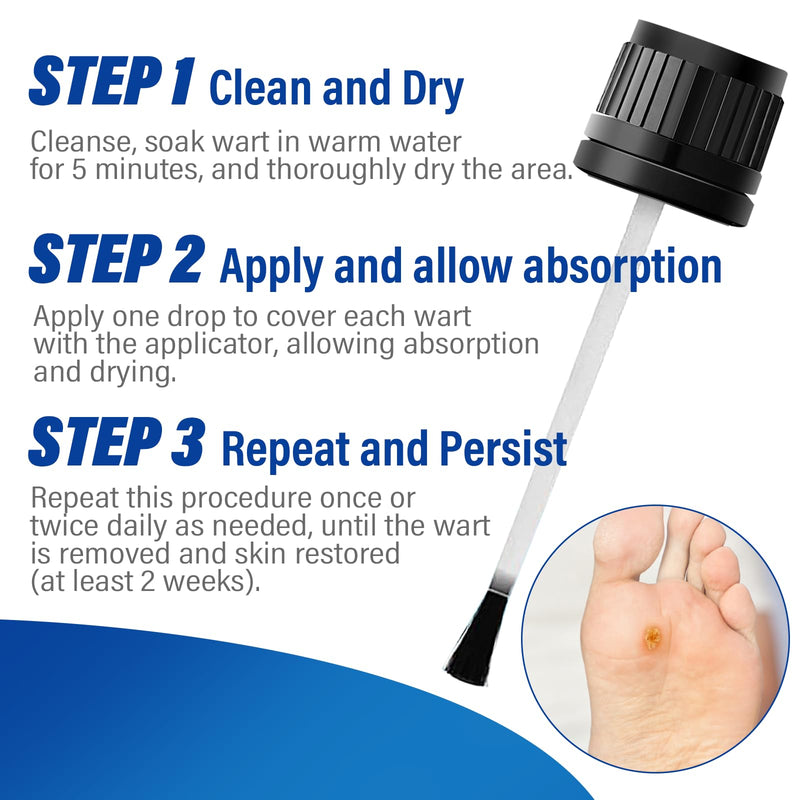 Wart Remover Liquid ‚Äì Fast Acting Salicylic Acid 17% Treatment for Plantar, Common and Flat Warts, Corn & Callus Removal ‚Äì 15ml Bottle