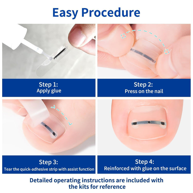 Ingrown Toenail Treatment, 10 packs Titanium Alloy Ingrown Toenail Corrector for all size foot, Ingrown Toenail Removal Kit for Curved Nail Repair, at Home Nail Kit Tools-Blue03
