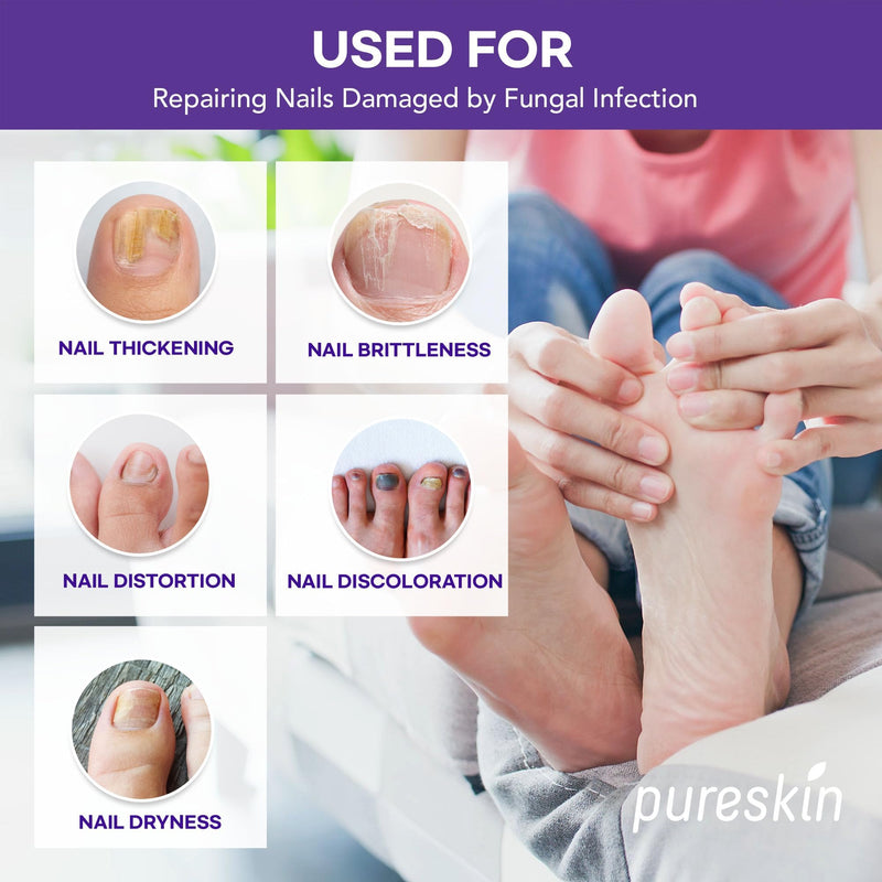 Extra Strength Toenail Fungus Treatment Patches: Nail Fungus Treatment for Toenail Fingernails - Nighttime Fungal Nail Patches Fungal Nail Repair - 21 patches 21 Patches Middle