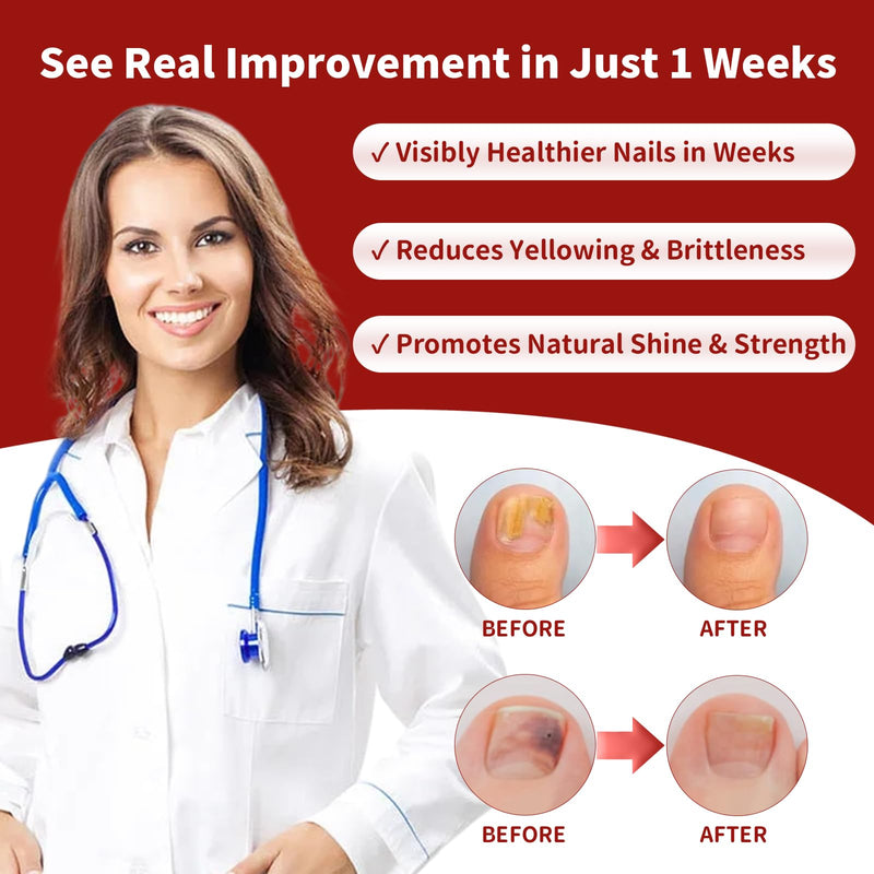 Toenail Fungus Treatment Extra Strength, Nail Fungus Treatment with Undecylenic Acid for Toenail & Fingernails, Antifungal Nail Repair for Athletes Foot, Ingrown, Thick, Broken, Damaged Nail, 30ml 1 Fl Oz (Pack of 1)