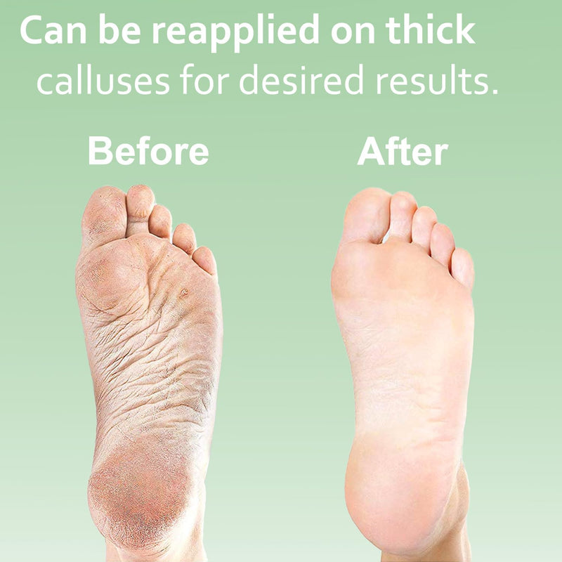 Callus Remover Gel & Double-Sided Foot File: 8 oz Extra Strength Callus Remover for Feet, Foot Callus Remover Care, Pedicure Tools Supplies, Spa Kit, Dead Skin Scrubber 8 oz Gel Double Sided File - BeesActive Australia