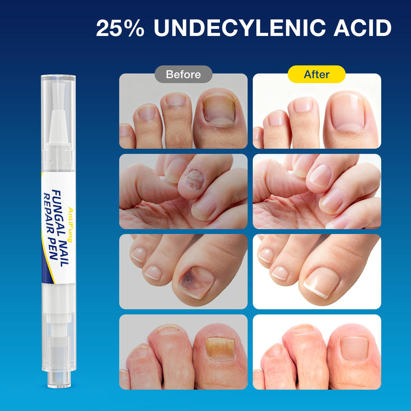 Toenail Fungus Treatment Extra Strength - AntiFung Pen with 25% Undecylenic Acid - Effective Nail Repair for Damaged Nails, Ingrown Nails & Discoloration - 3-Pack Applicator Pen