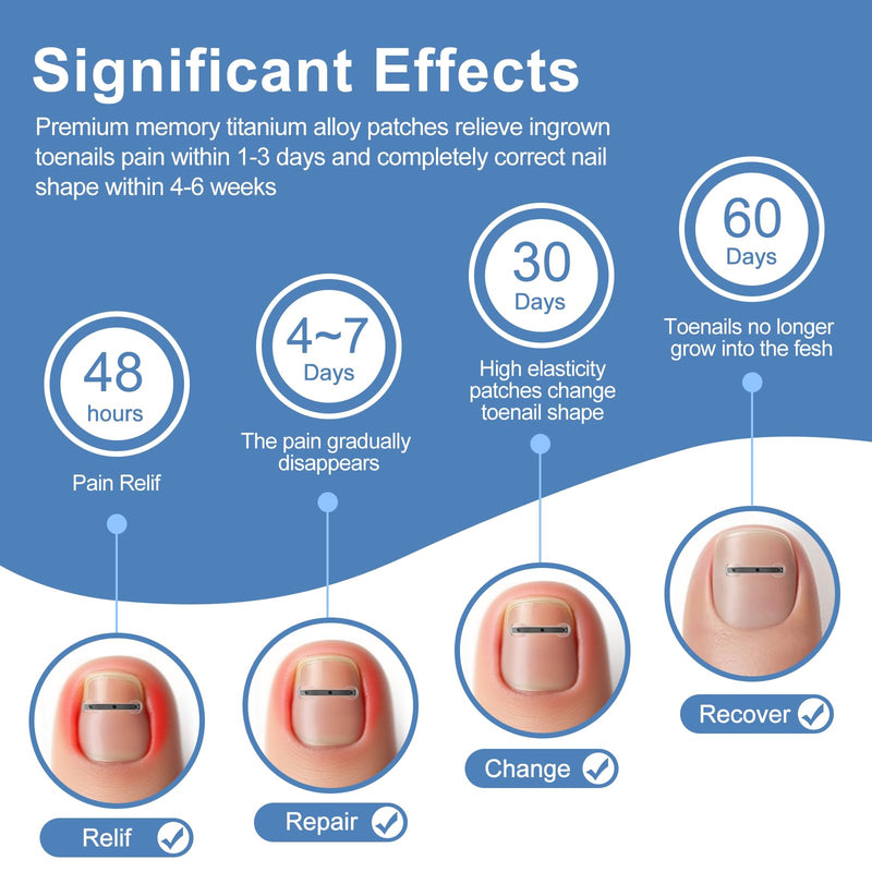 12Pcs Ingrown Toenail Corrector Strips for Curved Toenail Quick Relief,4 Multi-Sizes Ingrown Toenail Treatment Relief Tools Kit for Home Use