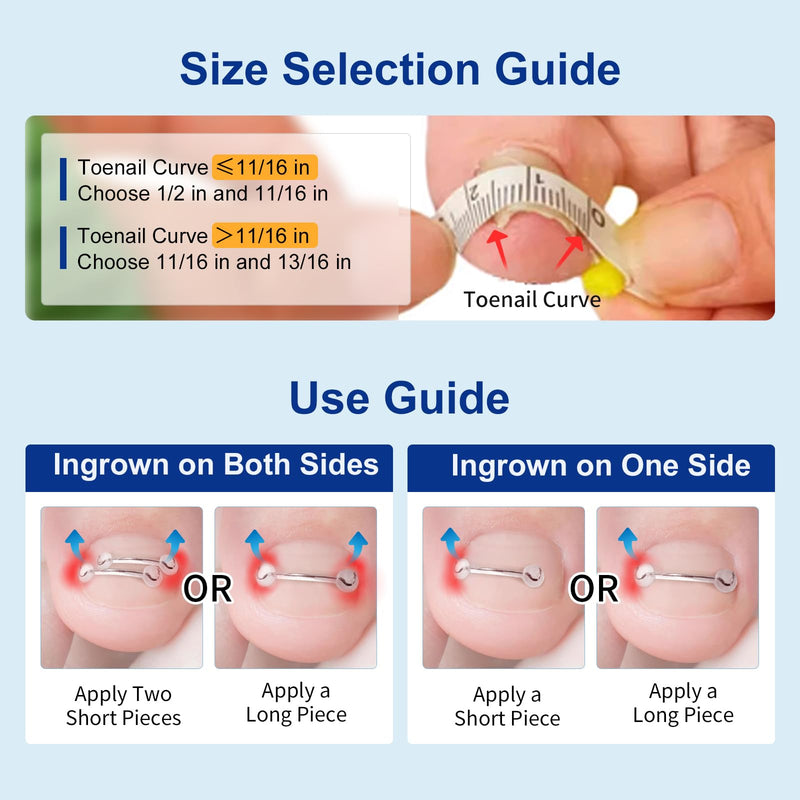 Nitinol Ingrown Toenail Corrector,at Home Ingrown Toenail Treatment,Curved Toenail Straightener,Ingrown Toe Nail Relief，Ingrown Toenail Removal Kit (11/16 In,13/16 In) 11/16 In,13/16 In