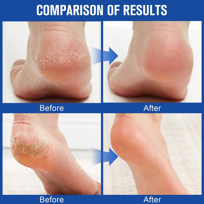 3PCS 60% Urea Hydrating and Anti-Cracking Foot Cream, Maximum Strength Urea Cream for Feet, Foot Lotion Stick for Heels, Dry Hands & Rough Knees, Smoothing Skin Women and Men
