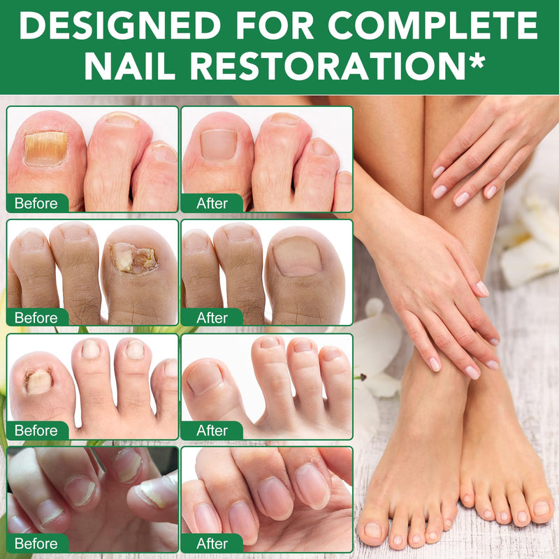 Toenail Treatment Extra Strength - 32 Pcs Nighttime Nail Patches for Toenails - Toe Nail Treatments for Nails Repair & Care - Easy to Use - BeesActive Australia