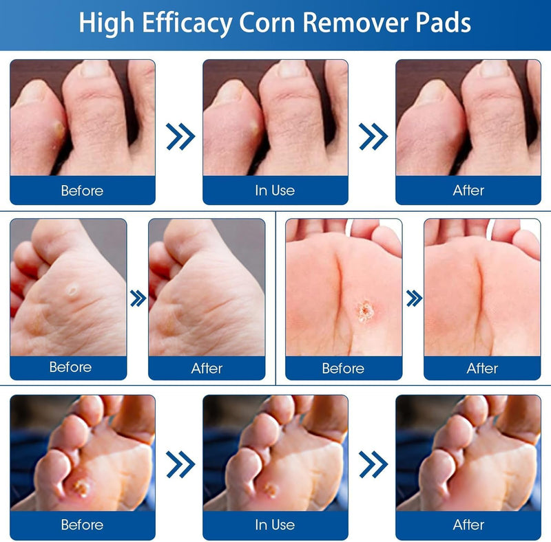 48 Count Corn Removal Pads for Feet and Toe, Corn Feet Remover for Extra Strength, Callous Remover - BeesActive Australia