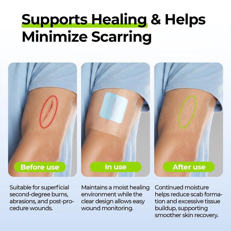 AUVON Hydrogel Burn Dressings 4" x 4" for Instant Cooling Relief & Moist Healing, Adhesive Burn Pads for 1st-2nd Degree Burns, Cuts, Abrasions, Waterproof Wound Dressing for Home First Aid Kit, 10 Pcs 4x4 Inch (10 Pcs)