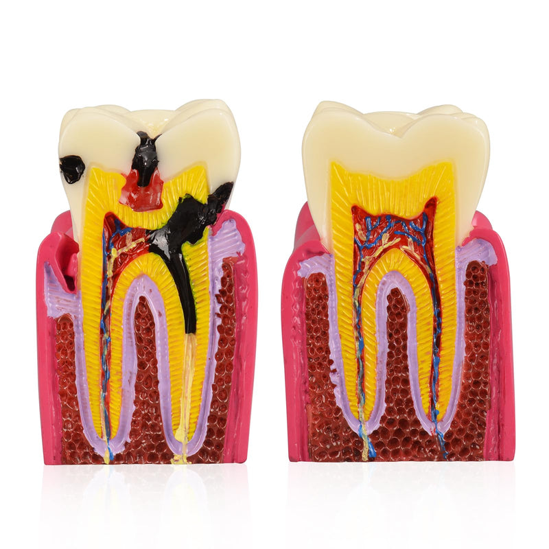 Ultrassist Dental Tooth Decay Model, Dental Caries Demonstration Model, Tooth Anatomy Teaching Model for Dental Education, Patient Explanation and Oral Health Classroom Teaching - BeesActive Australia