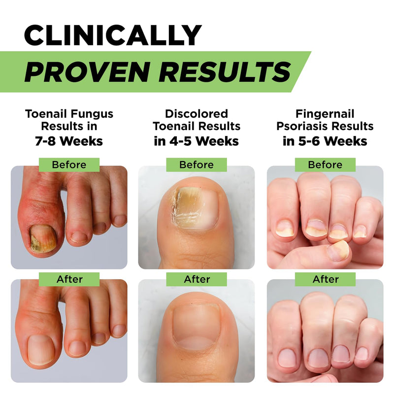 Footcure Antifungal Nail Treatment Pen – Extra Strength Toenail Fungus Treatment, 25% Undecylenic Acid for Toenails & Fingernails, Nail Fungus Repair Pen with Tea Tree & Oregano Oil, Made in USA 0.1 Fl Oz (Pack of 2)