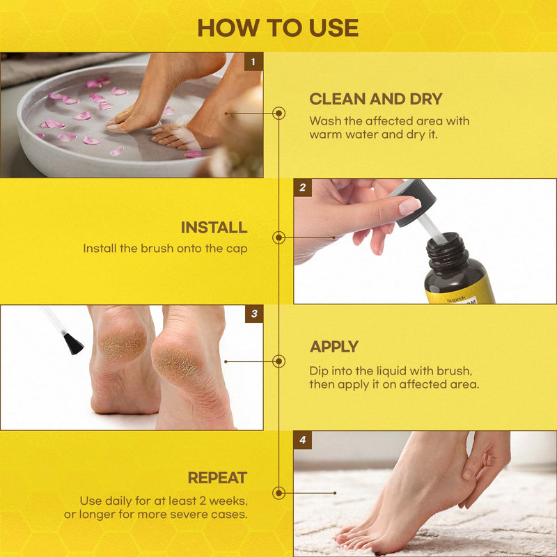 Fast-Acting bee Venom wart Remover: wart Freeze Off with salicylic Acid & bee Venom Cream - Wart Removal for Plantar Genital 18 ML