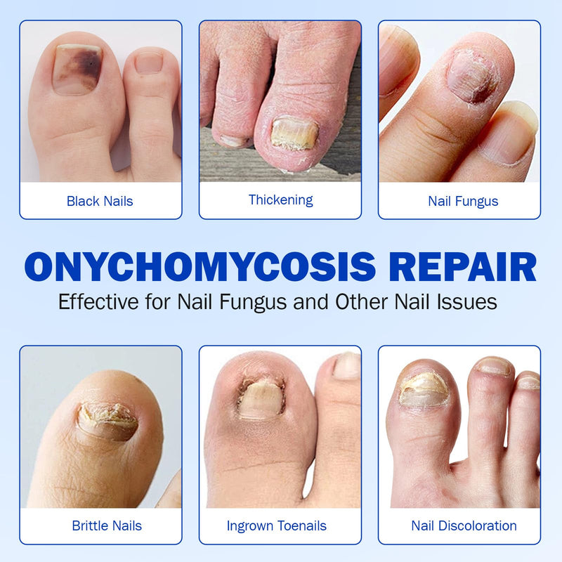 Fungal Nail Patches for Toenails (42 pcs), Fungal Nail Patches Extra Strength, Nighttime Repair Pads for Weak and Damaged Nails, Restore Discoloration and Thickness, Easy To Use - BeesActive Australia