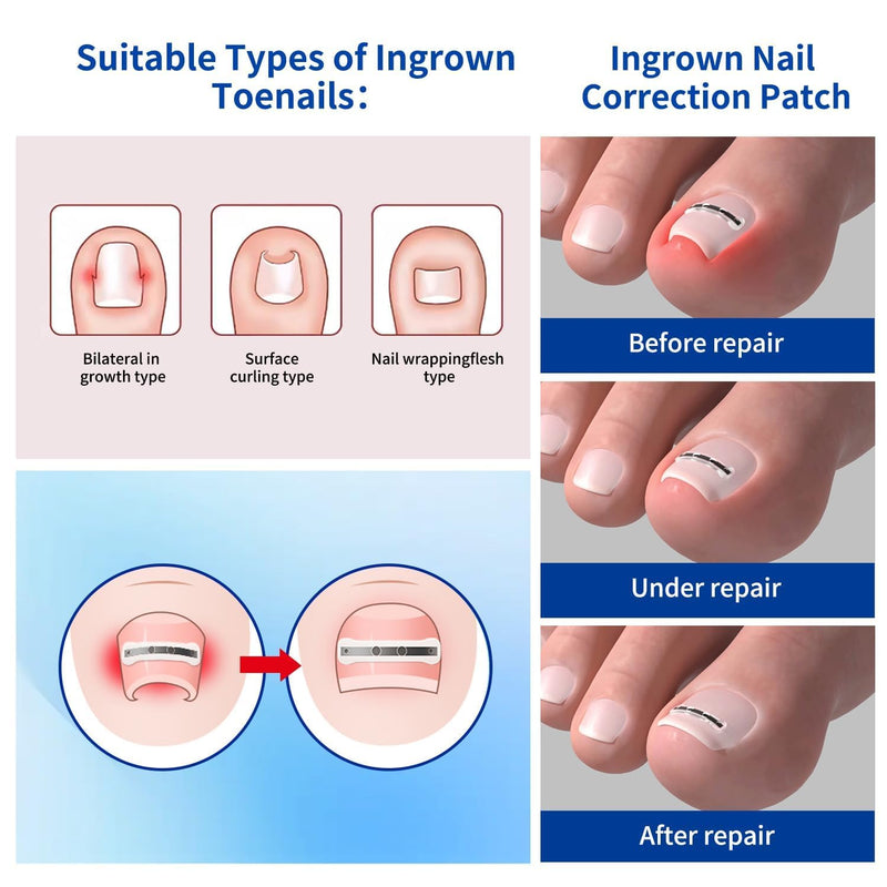 Ingrown Toenail Treatment, 10 packs Titanium Alloy Ingrown Toenail Corrector for all size foot, Ingrown Toenail Removal Kit for Curved Nail Repair, at Home Nail Kit Tools-Blue03