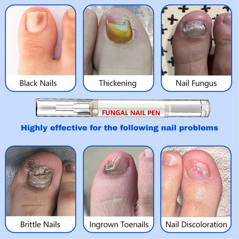 Fungal Nail Pen with Allicin & 25% Undecylenic Acid, Nail Repair Pen | Extra Strength Nail | Toenail & Fingernail Care 2pcs - BeesActive Australia