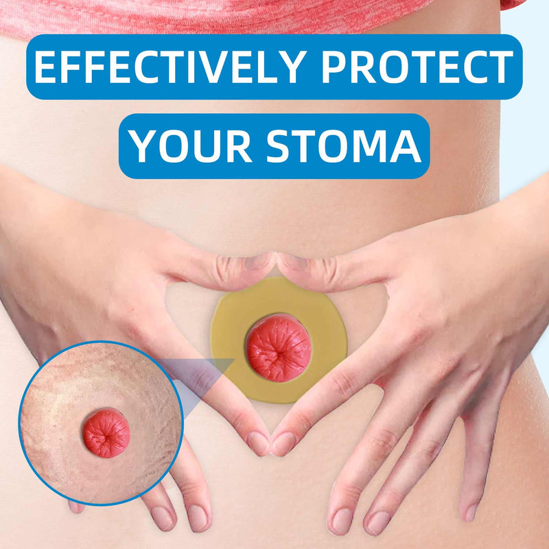 10PCS Ostomy Barrier Rings,Sting Free Moldable Ostomy Rings,Hydrocolloid Skin Extender Rings for colostomy Bags 2MM - BeesActive Australia