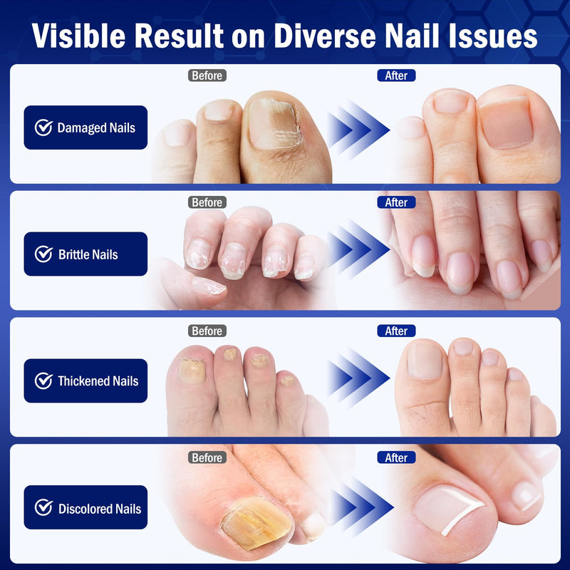 Toe Nail Fungus Renewal, 2-Pack Toenail Fungus Renewal, Fast Acting For Thick, Discolored, Broken & Damaged Toe & Finger Nail - BeesActive Australia