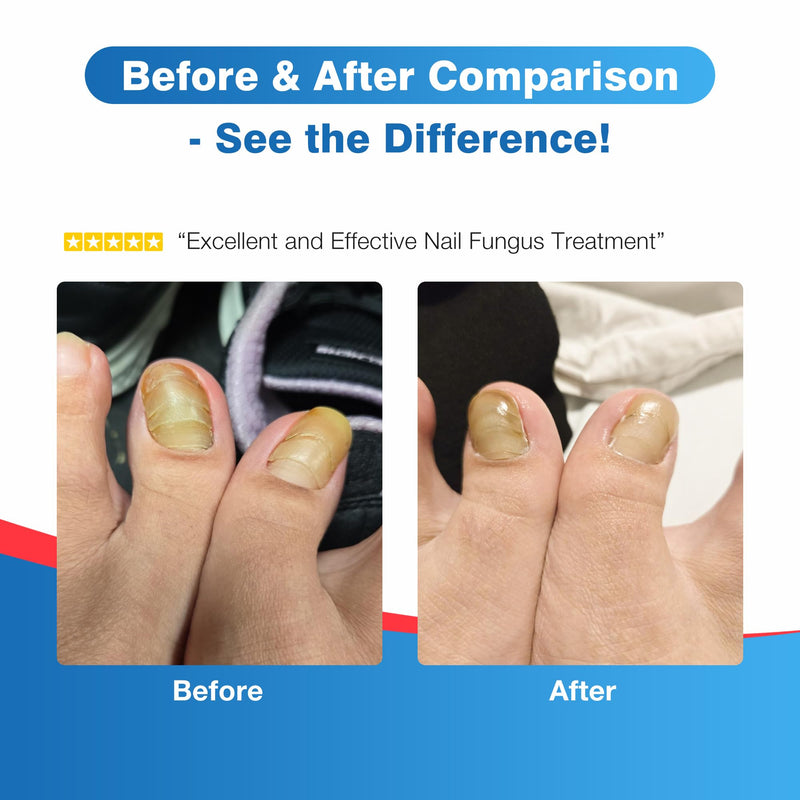 Toenail Fungus Treatment Extra Strength - DR.RAPID Toenail Fungus Treatment Pen with 25% Undecylenic Acid & Tolnaftate, Ideal for Fungus Treatment for Damaged Nails & Fingernails 5ml/0.18FLOZ 3Pcs 1 Count (Pack of 3)
