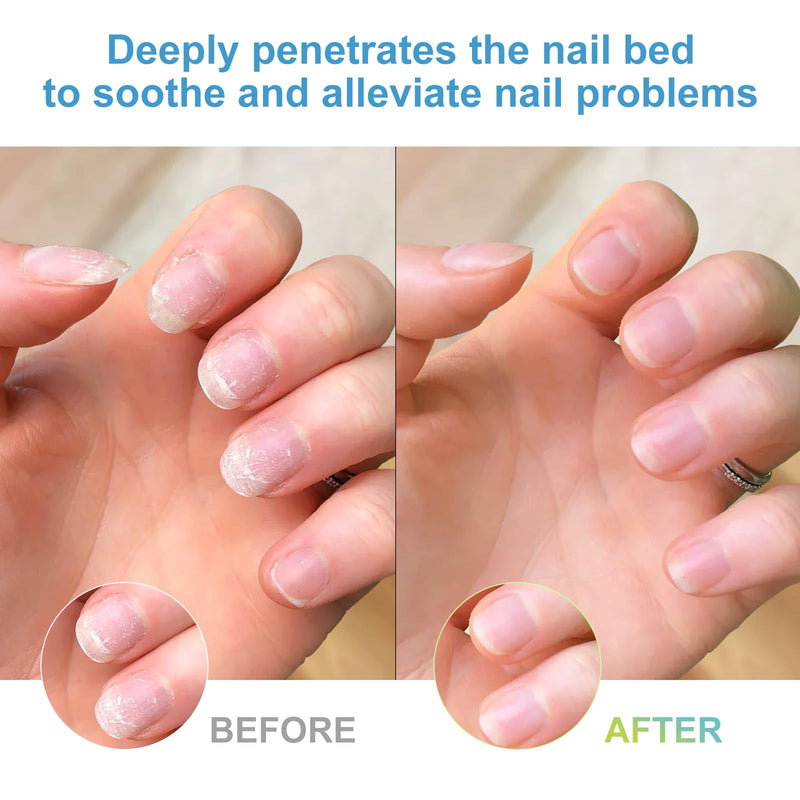 Nail Care Cream,Phrena Toenail Nail Repair for Damaged,Natural Formula with Tea Tree Oil, Oregano Oil,Vitamin E & Allantoin,60ml/2.03fl.oz