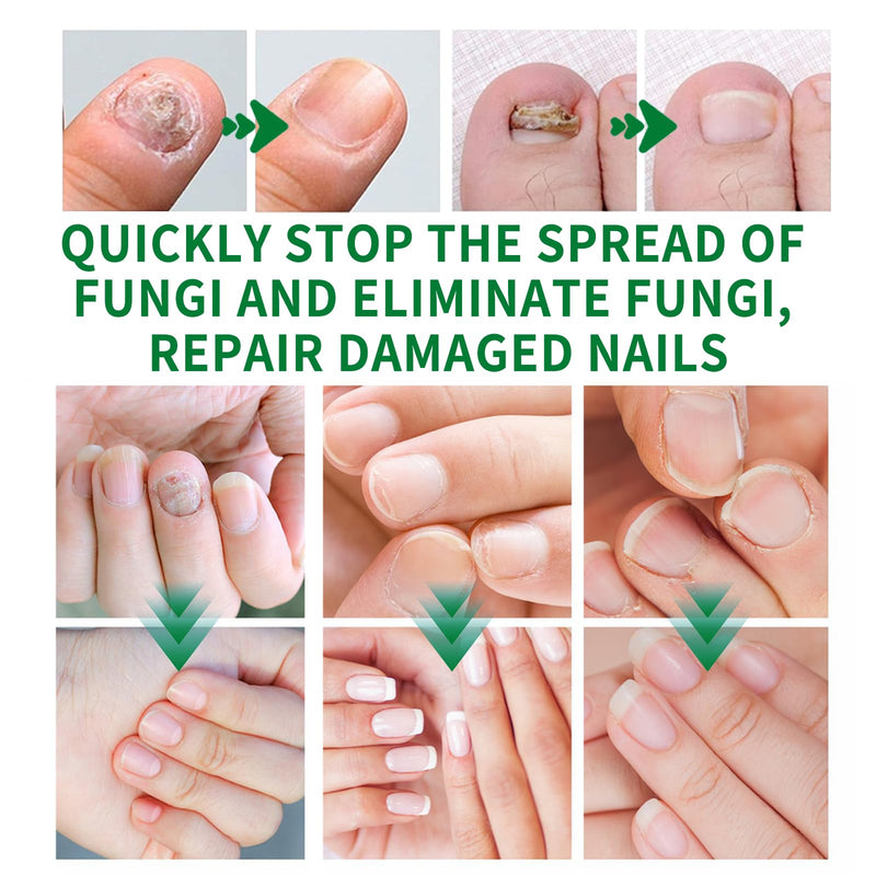 Nail Fungus Treatment Gel, Nail Fungus Treatment Cream,Multi-Purpose Nail Repair Oil Serum (2pcs) 2pcs