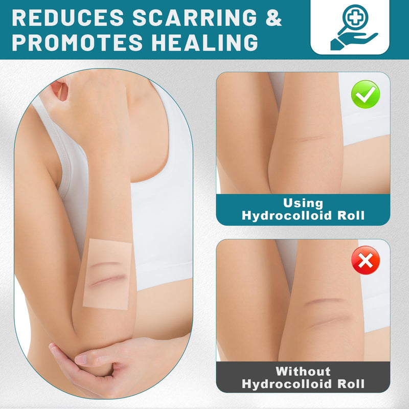 Hydrocolloid Roll for Wound Care, 2in*6.6ft Hydrocolloid Bandages