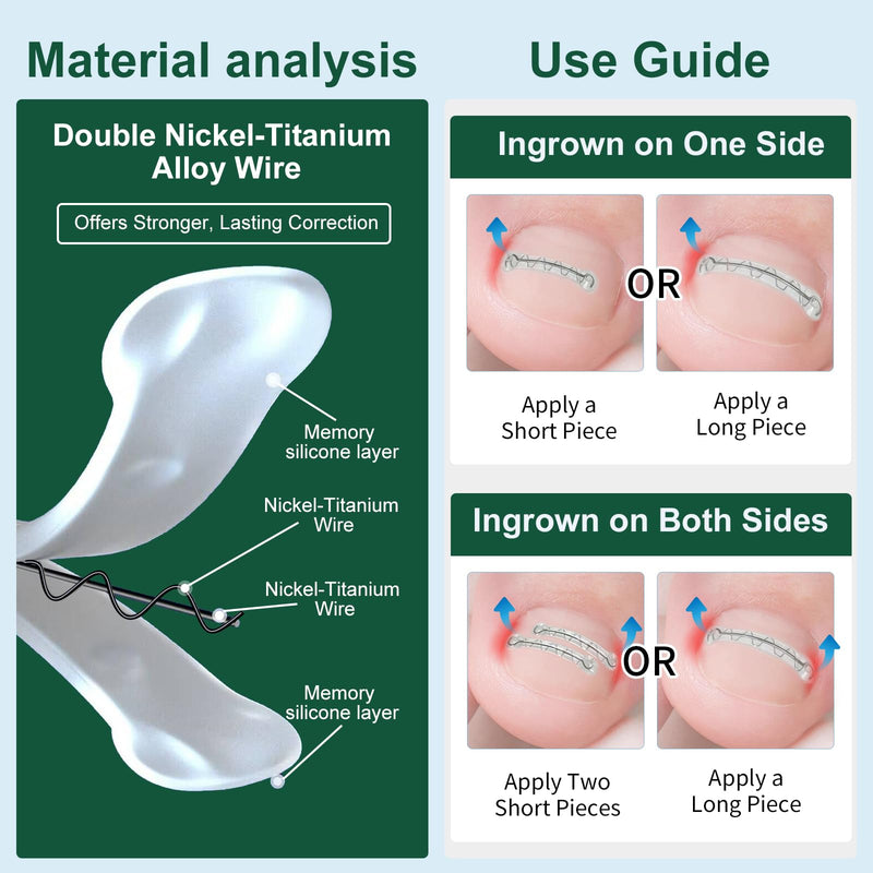 Dual Nitinol Ingrown Toenail Corrector,Ingrown Toenail Treatment,Curved Toenail Straightener,Ingrown Toenail Removal Kit,Big Toe Ingrown Toenail Tool (0.55in,0.66in) 0.55in,0.66in - BeesActive Australia