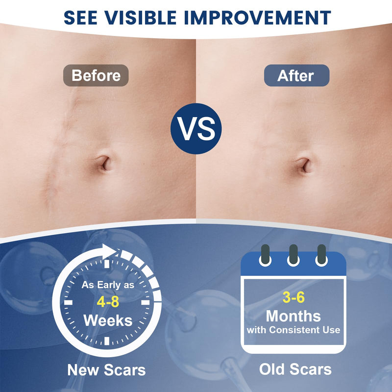 Rvlaim 100% Silicone Scar Gel Scar Cream, Advanced Silicone Gel for Removal of Surgical, Burns, Acne Scar, Old and Recent Scars and Stretch Marks, 1.7 oz/50ml 50ML