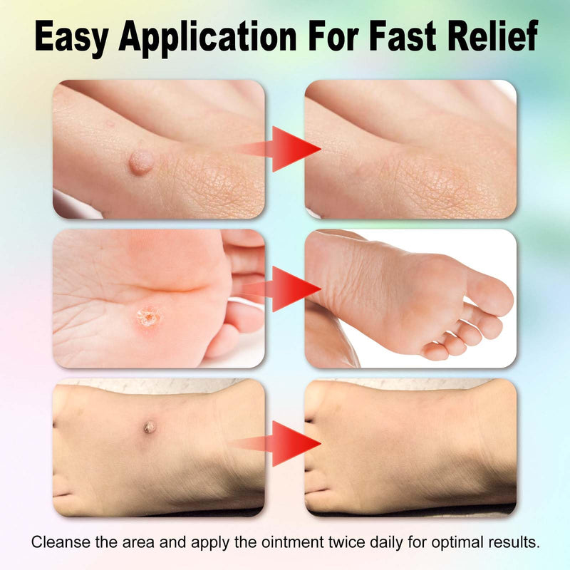Fast-Acting Wart Remover Gel with 17% Salicylic Acid - Fast-Acting to Remove Common, Flat, Plantar Warts, and HPV Warts - Professional Strength, Natural Formula for All Skin Types 1 Pack - BeesActive Australia